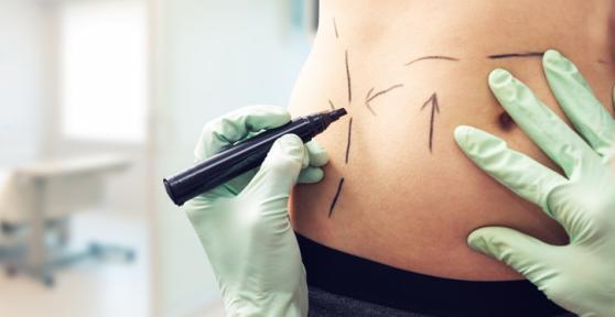 Las mejores clínicas de liposucción en Madrid