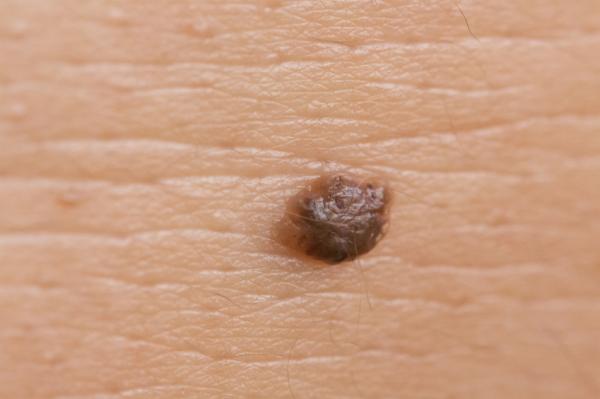 Verrugas en el cuello: causas y remedios