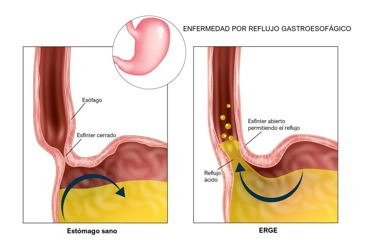 Cuánto tiempo tarda en curarse el reflujo gastroesofágico