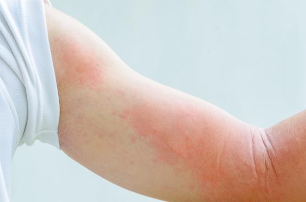 Remedios naturales para combatir la alergia nerviosa de piel