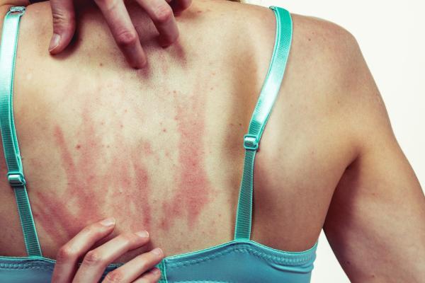 Picor en las piernas sin sarpullido: causas - Cómo aliviar el picor en las piernas