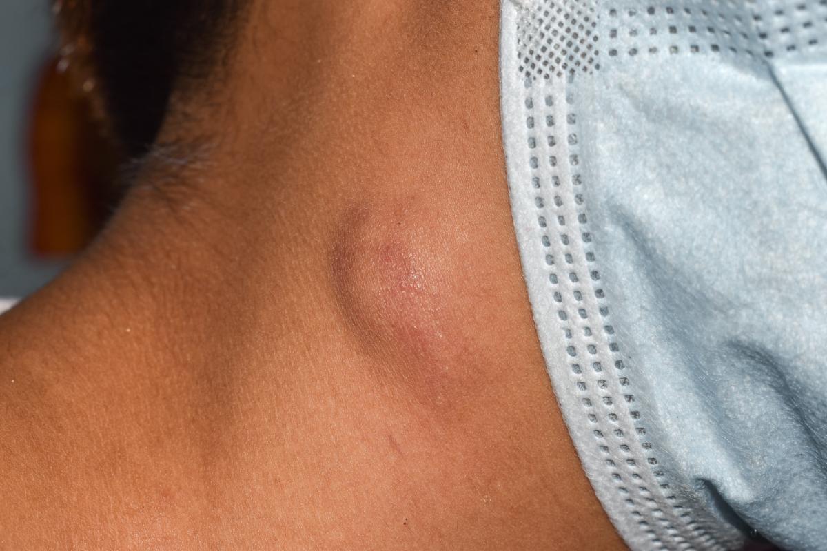 Cuánto dura un ganglio inflamado en el cuello
