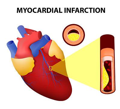 Infarto de miocardio: síntomas, causas y tratamiento - Funcionamiento del corazón