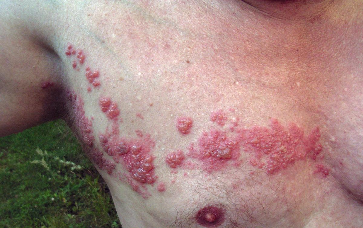 ¿Se puede mojar la zona afectada por herpes zóster?