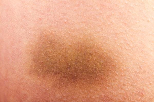 Moretones amarillos sin golpe: ¿por qué salen y cuándo preocuparse?
