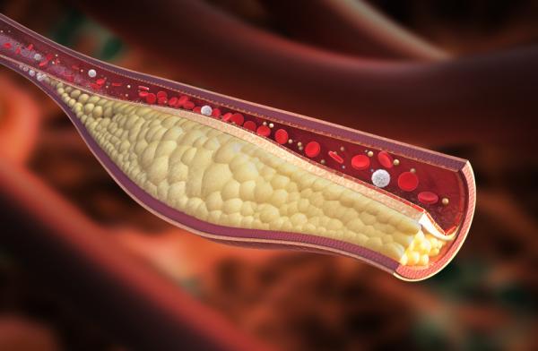 Infusiones para limpiar las arterias - Enfermedades cardiovasculares más comunes 