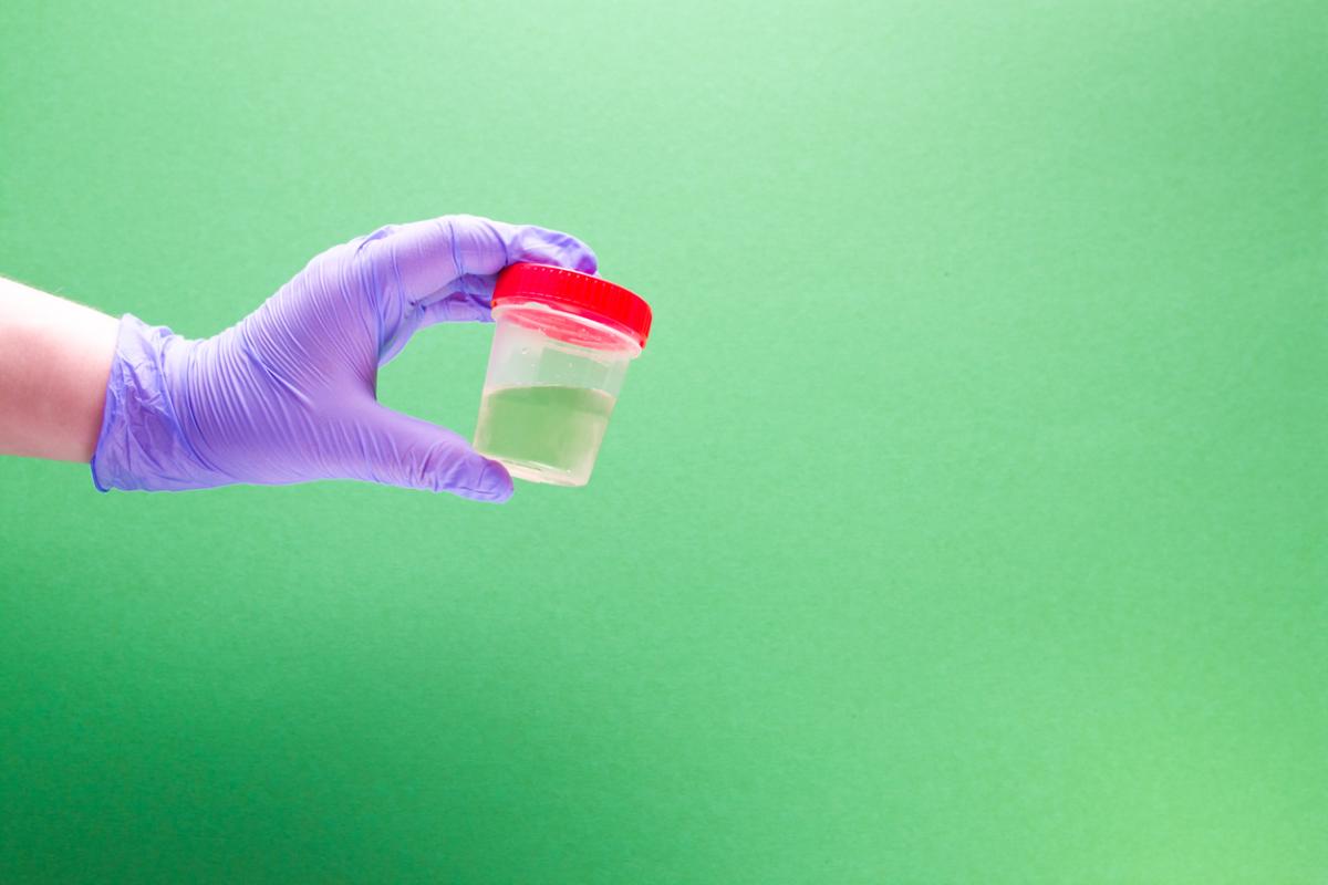 Orina verde: causas y tratamiento