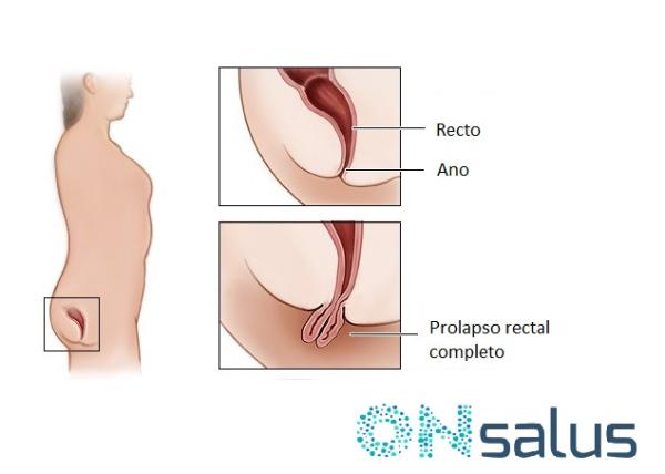 Prolapso rectal: causas, síntomas, grados y tratamiento