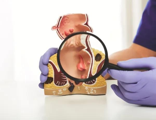 ¿Puedo usar Hemoal si hay sangrado por hemorroides? - ¿Cuándo NO usar Hemoal con sangrado?