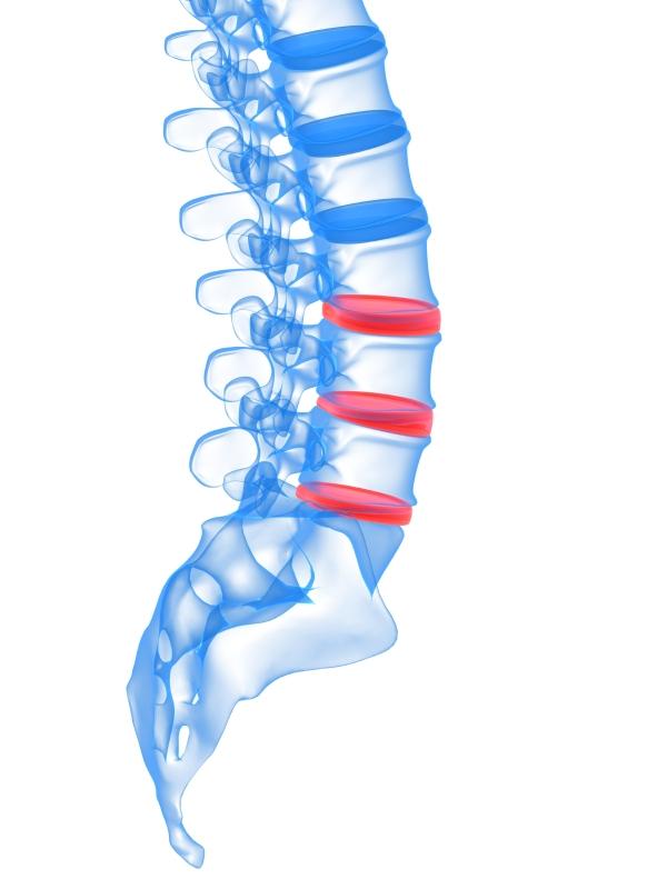 Qué ejercicios hacer si tengo hernia de disco en la región lumbar - ¿Qué es una hernia de disco?