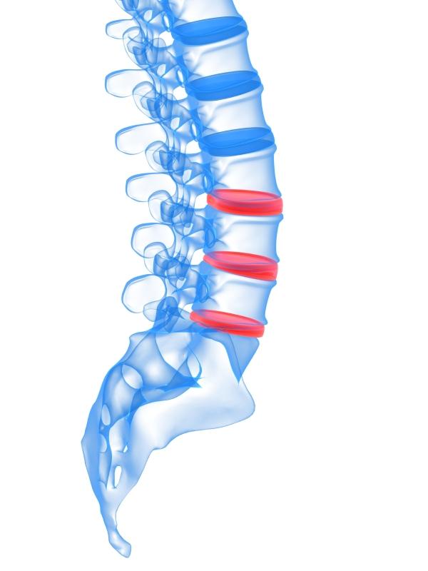 Qué ejercicios hacer si tengo hernia de disco en la región lumbar - ¿Qué es una hernia de disco? 