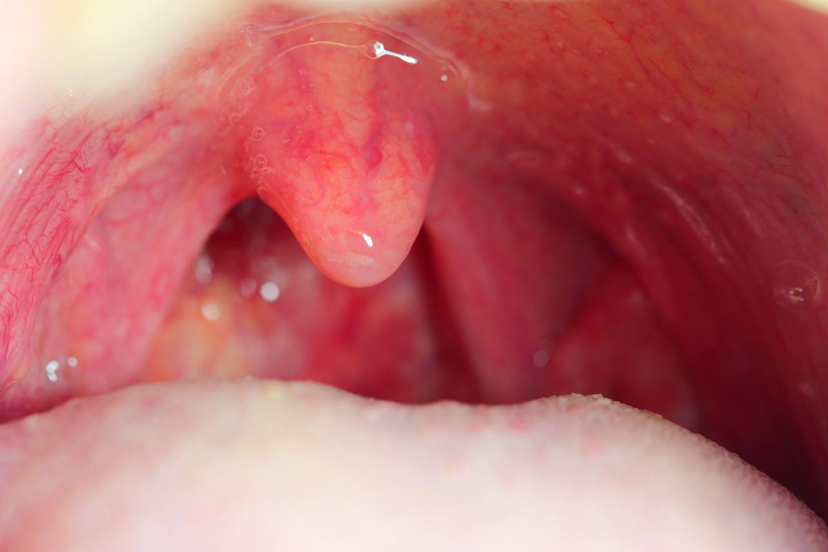 ¿Las anginas se contagian?