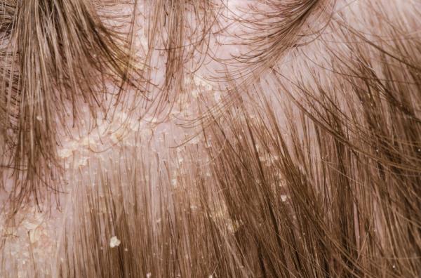 Beneficios del vinagre de manzana para tu pelo - Trata la caspa