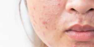 Acné quístico: causas, tratamiento y remedios naturales