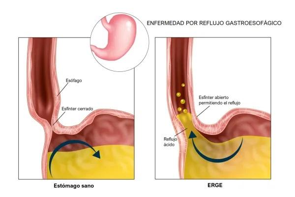 Por qué cuando estornudo me duele el pecho - Acidez estomacal