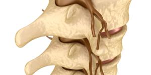 Mielopatía cervical: síntomas, causas y tratamiento