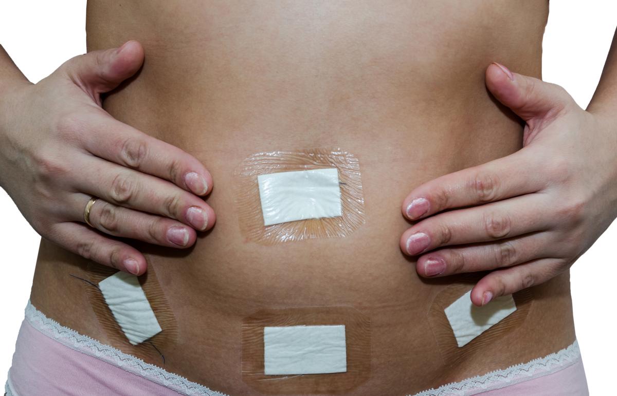 ¿Es normal tener la barriga hinchada después de una laparoscopia?