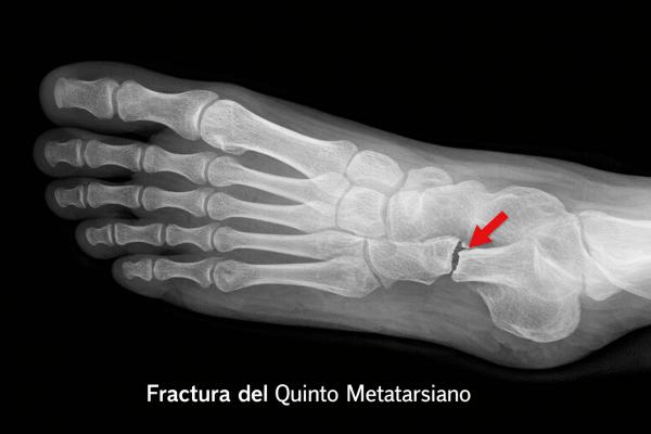 Dolor en el lateral externo del pie: causas y tratamientos - Fractura del quinto metatarsiano
