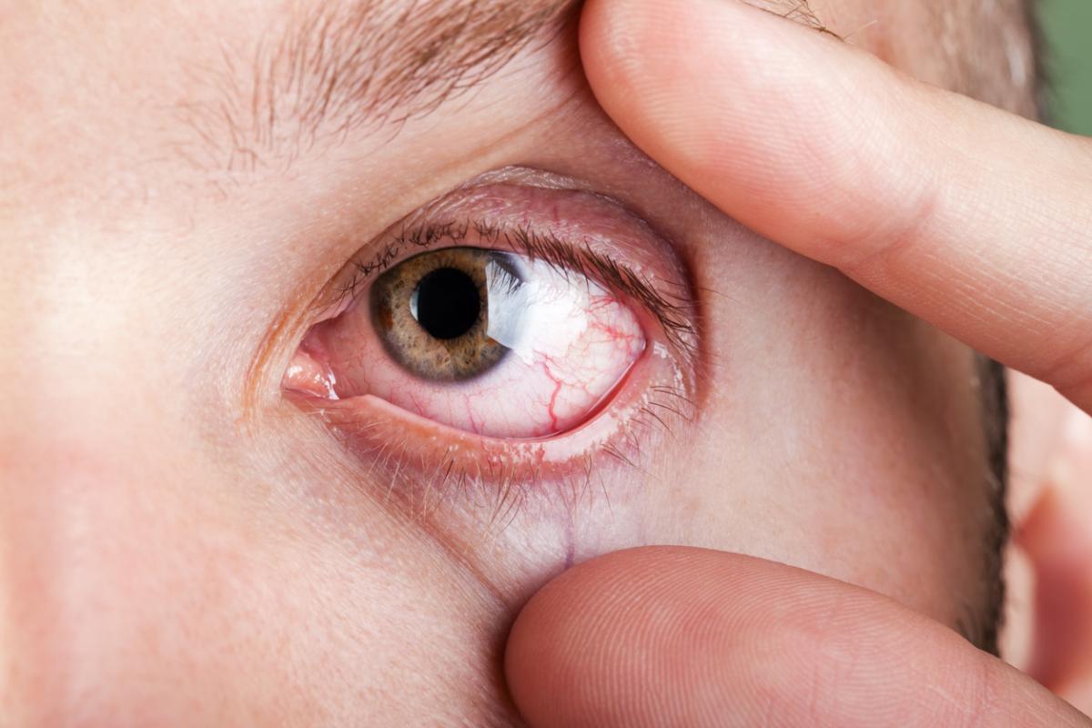 Cisticercosis ocular: síntomas y tratamiento