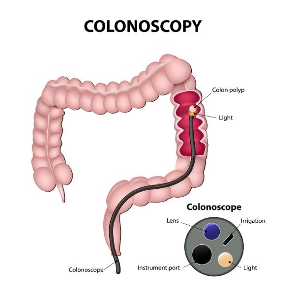 Colon distendido: qué es, causas y tratamiento - Tratamiento del colon distendido