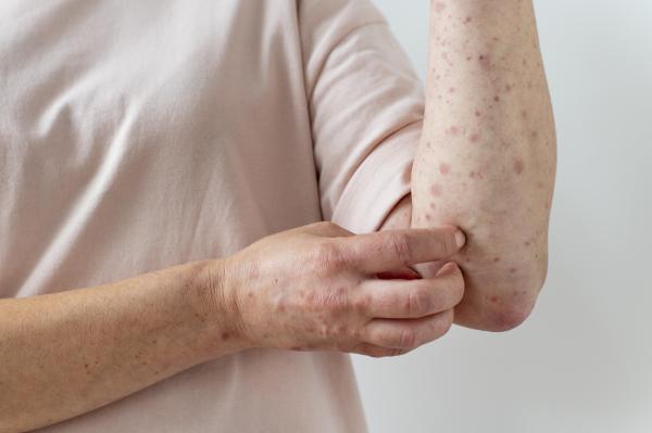 Me duele la piel como si estuviera quemada: causas y tratamiento - Erupciones en la piel y reacciones alérgicas
