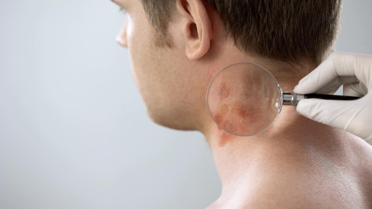 Sarpullido en el cuello: causas y tratamiento