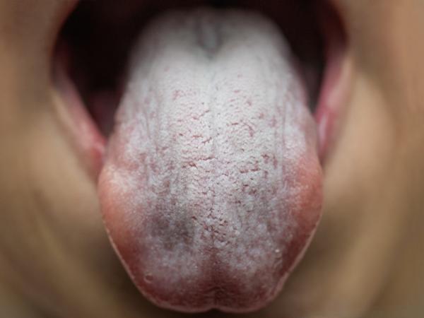 Paladar blanco: causas y tratamiento - Candidiasis