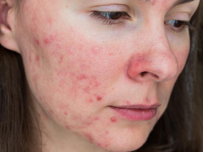 Acné pápulopustuloso Características y tratamiento médico y natural