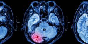 Síntomas de un accidente cerebrovascular