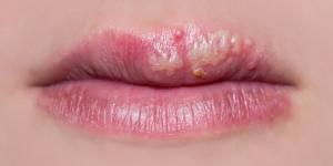 Herpes labial recurrente: causas, síntomas y tratamiento