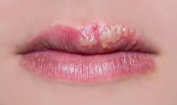 Herpes labial recurrente: causas, síntomas y tratamiento