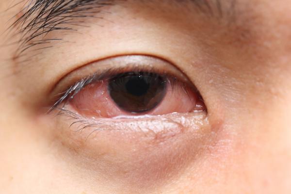 Cómo bajar la hinchazón de los ojos - Por qué tengo los ojos hinchados - causas principales