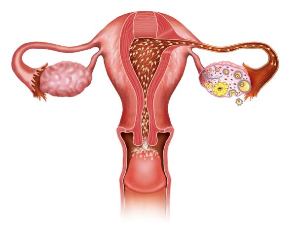 Cómo desinflamar el abdomen después de una histerectomía - Qué es la histerectomía