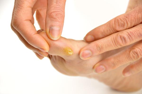 Heridas entre los dedos de los pies: por qué salen y cómo curarlas - Hiperqueratosis plantar