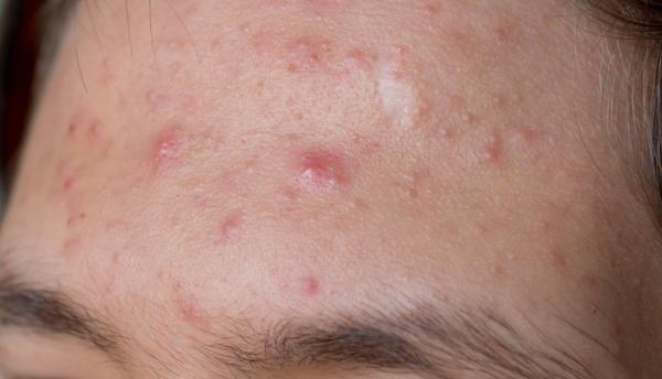 Cómo eliminar el acné hormonal - ¿Cuáles son los síntomas del acné hormonal?