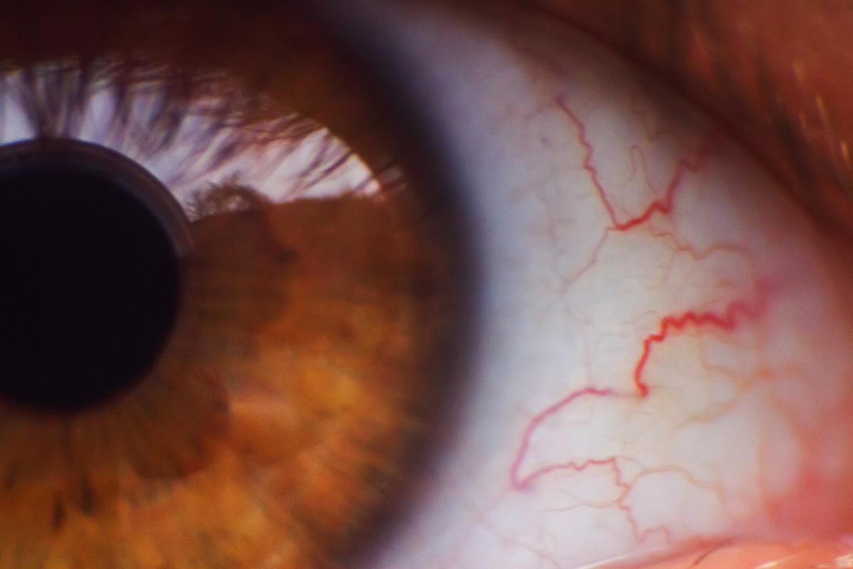Venas rojas en los ojos: causas y cómo quitarlas