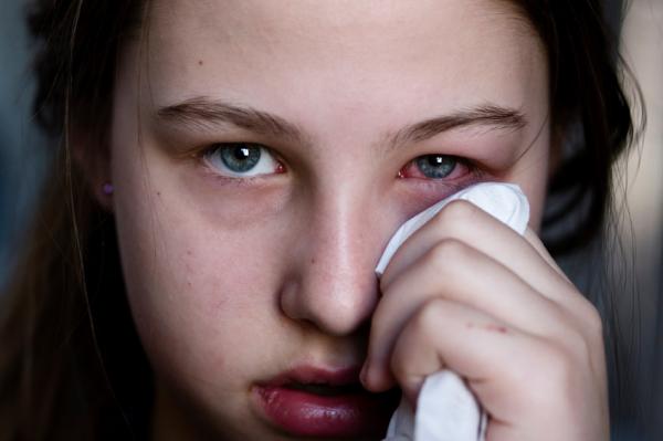 Por qué tengo el ojo rojo - Ojos rojos por infecciones 