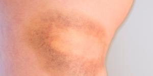 Cómo saber si un hematoma es grave