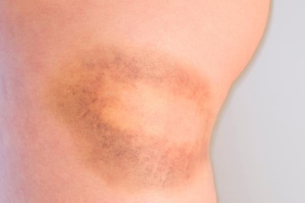 Cómo saber si un hematoma es grave