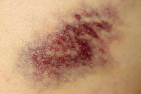 Cómo saber si un hematoma es grave - Qué es un hematoma