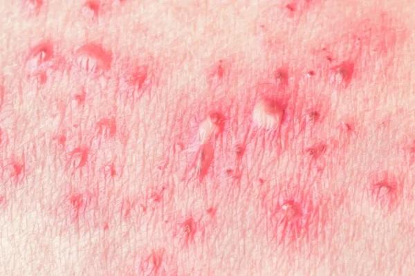 Sarpullido en la espalda: causas y tratamiento - Herpes zóster