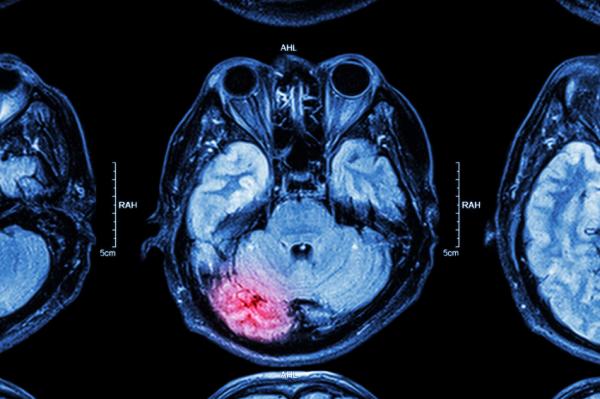 ¿Los infartos cerebrales se curan?