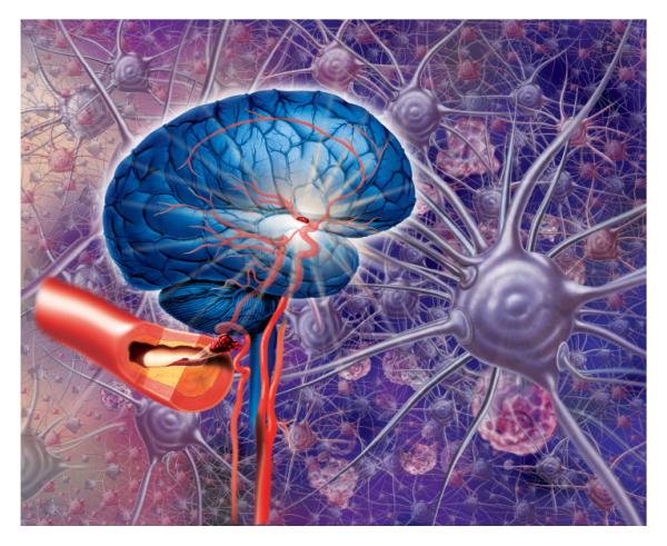 ¿Los infartos cerebrales se curan? - ¿Un infarto cerebral se puede curar?