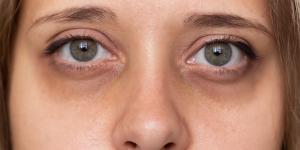 ¿Tener ojeras es síntoma de alguna enfermedad?