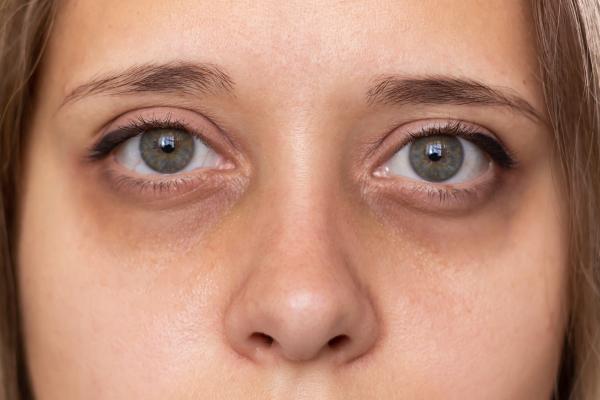 ¿Tener ojeras es síntoma de alguna enfermedad?