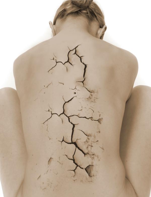 Osteoporosis: síntomas, tratamiento y prevención