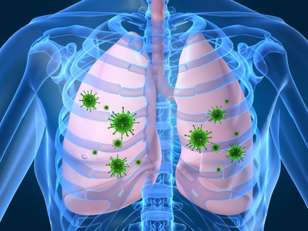 Dolor en los pulmones al toser: causas - Dolor en los pulmones al respirar y toses: neumonía