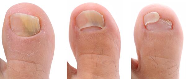 ¿Los hongos en las uñas duelen? - ¿Cómo tratar los hongos en las uñas?