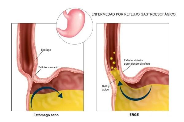 Eructar después de beber agua: causas y tratamiento - Reflujo gastroesofágico