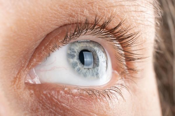 Mancha blanca en el iris del ojo: causas y tratamiento